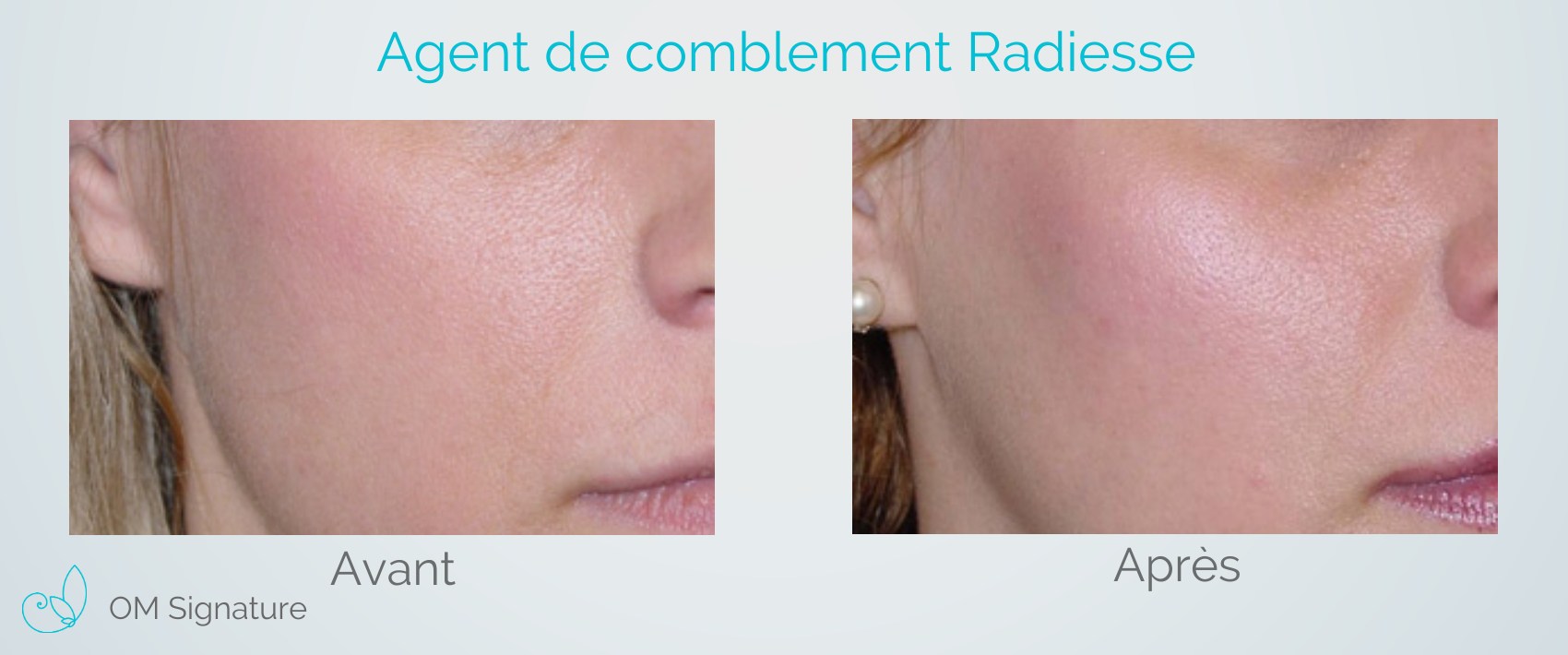 Injection De Radiesse Clinique M dico Esth tique St Lambert Injection De Radiesse Clinique M dico Esth tique St Lambert